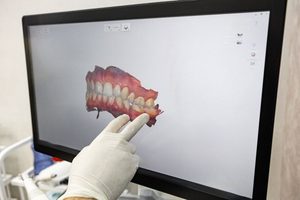 Gloved hand pointing at digital scan of teeth on computer monitor 